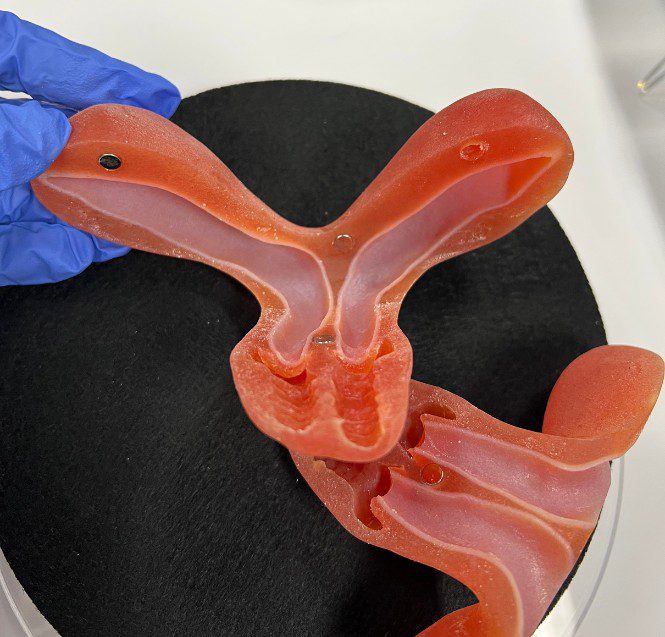 Uterus didelphys Uterus didelphys