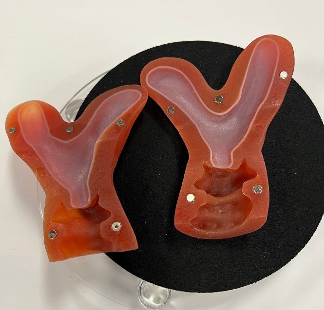 bicornuate uterus bicornuate uterus