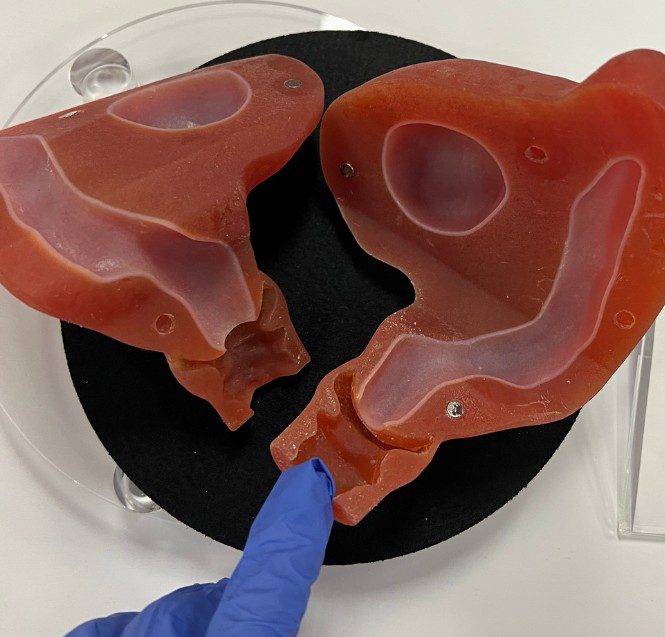 unicornuate uterus unicornuate uterus