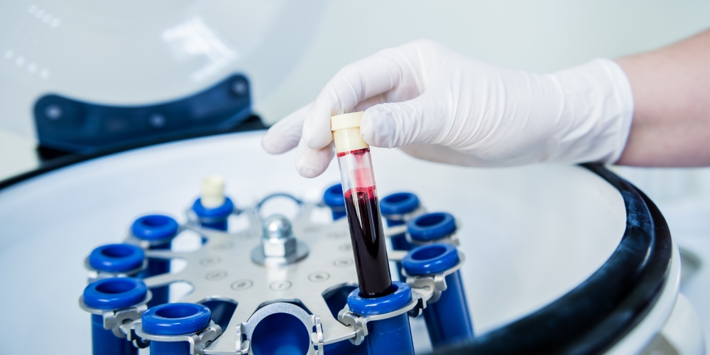 platelet rich plasma therapy platelet rich plasma therapy
