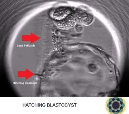 blastocyst hatching