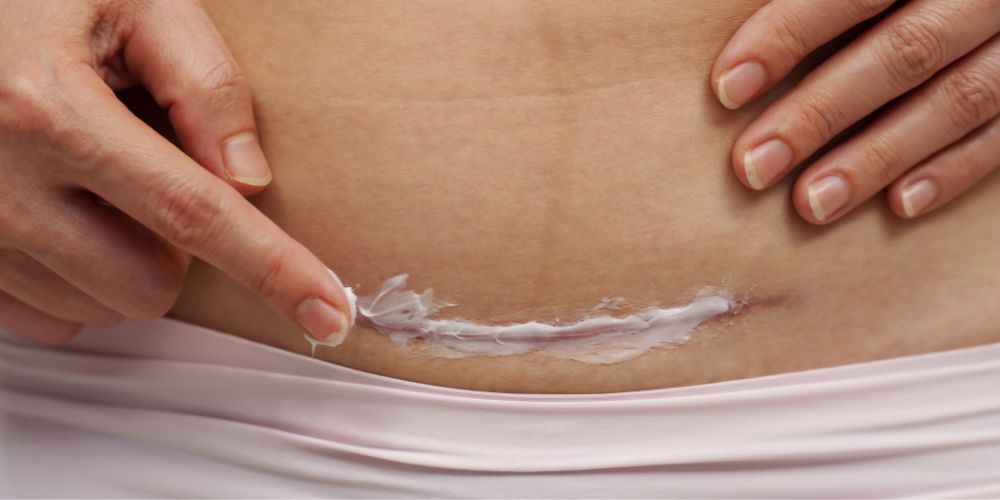 c section scar recovery