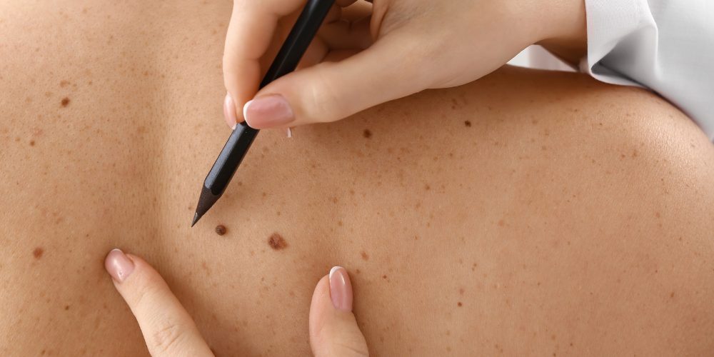 difference between mole and freckle