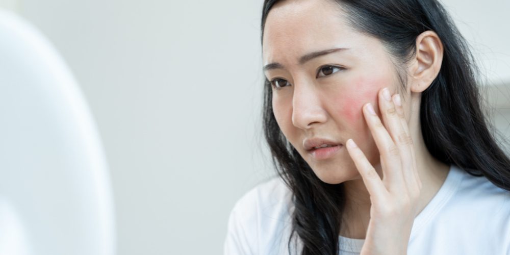 _does rosacea get worse with age_ _does rosacea get worse with age_