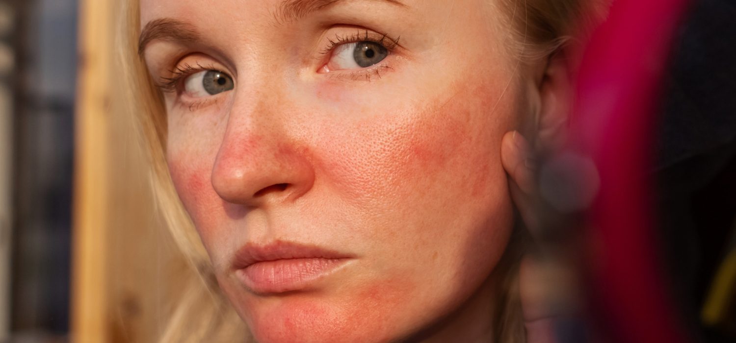 is rosacea an autoimmune disease_